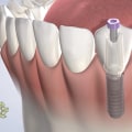 Oral Hygiene Instructions After Dental Implant Surgery
