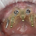 Closing the Incision: A Guide to the Dental Implant Procedure