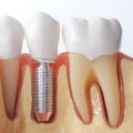 Pros and Cons of Dental Implants: What You Need to Know