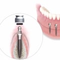 The Pros and Cons of Mini Dental Implants: A Comprehensive Comparison