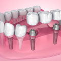 Possible Complications of Dental Implant Procedure