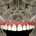 Understanding Zygomatic Implants: What You Need to Know