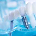 Maintaining Good Oral Hygiene: A Guide to Long-Term Care for Dental Implants