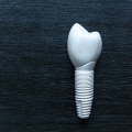 Everything You Need to Know About Metal-Free Implants