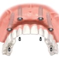 The Cost of Dental Implants: Understanding the National Average Cost