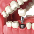 The Importance of an Initial Consultation for the Dental Implant Procedure