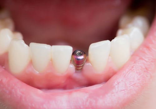 Understanding the Healing Process After Dental Implant Surgery