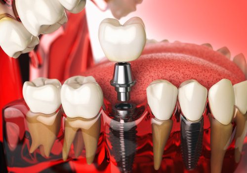 Pros and Cons of Traditional Dental Implants: A Comprehensive Guide