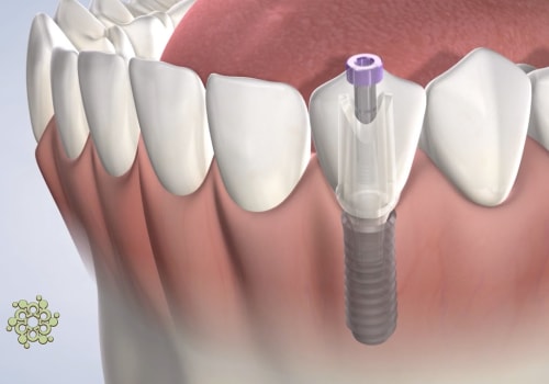 Oral Hygiene Instructions After Dental Implant Surgery