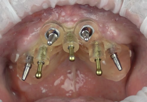 Closing the Incision: A Guide to the Dental Implant Procedure