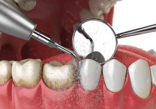 Regular Check-Ups and Cleanings: Maintaining Your Dental Implants
