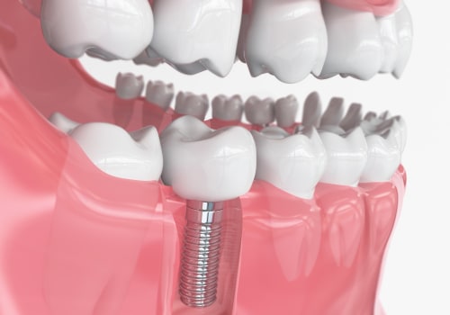 Understanding Different Types of Dental Implants