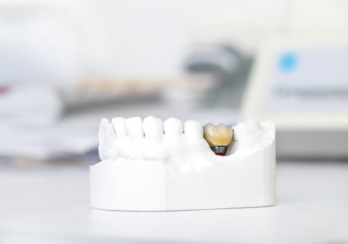 The Fusing of Implant to Jawbone: What You Need to Know