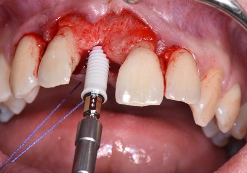 A Look into Zirconia Implants: The Ultimate Guide to Dental Implants and Materials Used