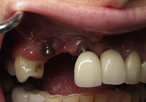 Possible Complications to Watch For After Dental Implant Surgery