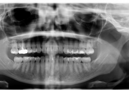 Dental Exam and X-rays: What You Need to Know