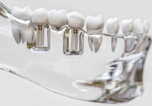 Financing Options for Dental Implants: How to Save on Your Smile