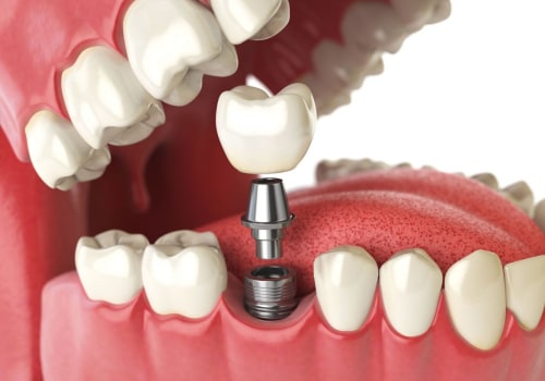 The Importance of an Initial Consultation for the Dental Implant Procedure